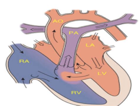 Peds Cardiology Flashcards Quizlet