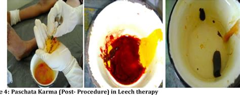 Leech Therapy Therapeutic Effects Procedure And Benefits Santripty