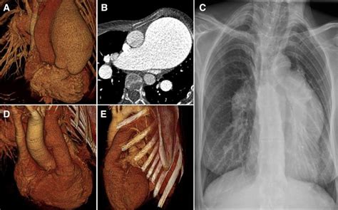 Marfan Syndrome Lungs