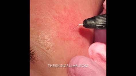 Thermavein Thread Vein Removal At The Skin Cellar Youtube