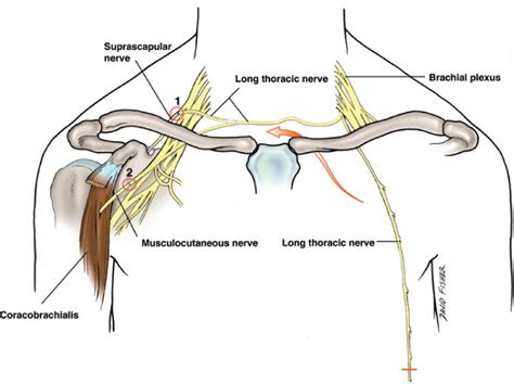 Long Thoracic Nerve Entrapment