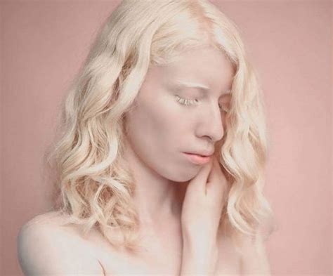 How Albinos From Various Races Look Like 22 Pics