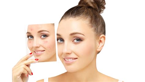 Acne Scar Treatment In Ahmedabad Sm Wellness