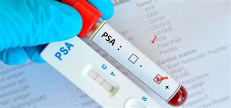 Prueba De Ant Geno Espec Fico Prost Tico Psa Laboratorio Bioanalisis