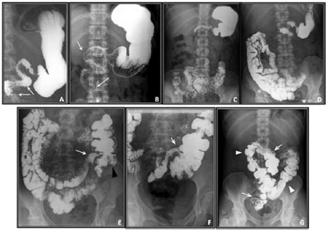 A B Contrast Gastrointestinal Series Duodenal Malrotation And Download Scientific Diagram