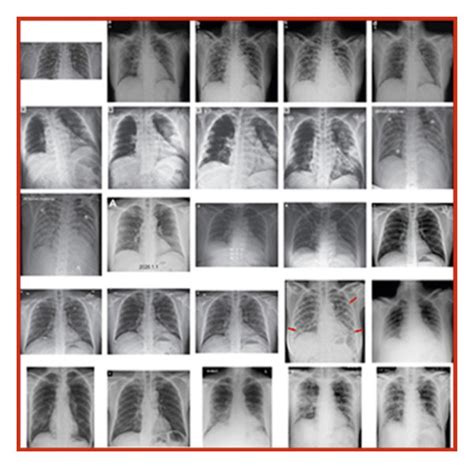 Chest X Ray Image Dataset A Normal Persons’ X Ray Images I E Download Scientific Diagram