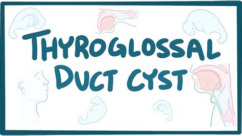 Thyroglossal Duct Cyst Anatomy