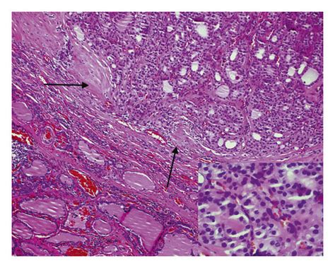 Minimally Invasive Follicular Thyroid Carcinoma Showing Invasion