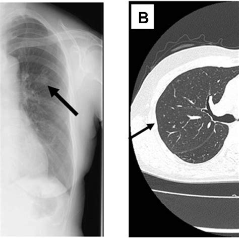 Chest X Ray A And Computed Tomography Ct B Findings Of Patient 1 Download Scientific