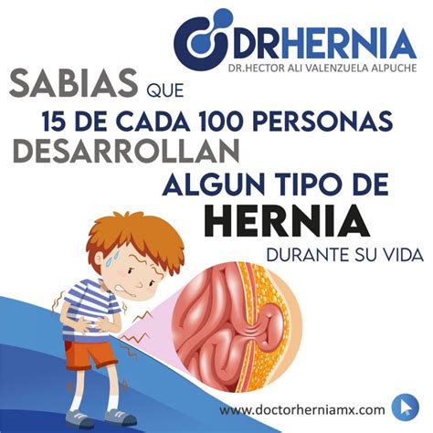 Indicaciones Antes Y Después De Tu Cirugía De Hernia Doctor Hernia