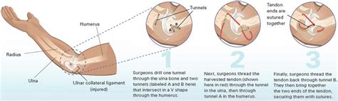 Anatomy Ulnar Collateral Ligament Reconstruction Aka Tommy John Surgery