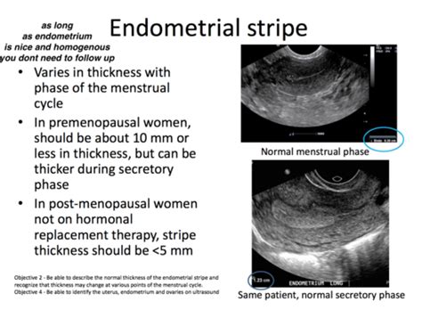 Endometrial Hyperplasia and Endometrial CA Flashcards | Quizlet