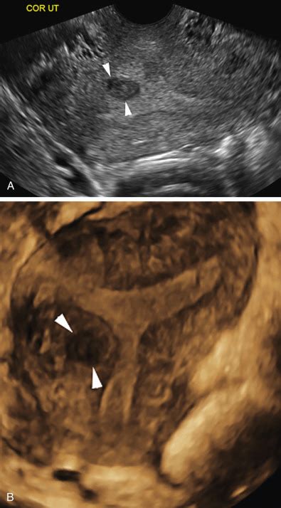 Sonographic Imaging In Infertility And Assisted Reproduction