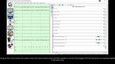 Natus Neuroworks Eeg Latingerty