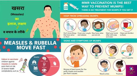 Measles Mumps Rubella Mmr Introduction Sign And Symptoms Diagnosis Treatment And