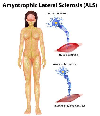 Sclérose latérale amyotrophique féminine 301683 Art vectoriel chez Vecteezy