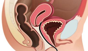 Sindrome Genitourinario En La Menopausia