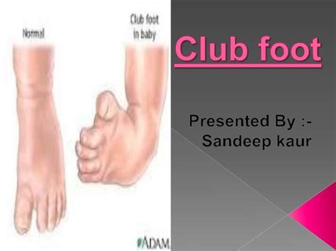 Club Foot