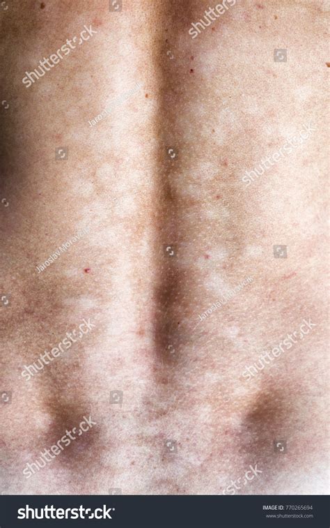 Tinea Versicolor Pityriasis Versicolor Fungal Infection