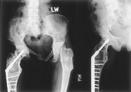 Preoperative Left And Postoperative Right Long Cassette