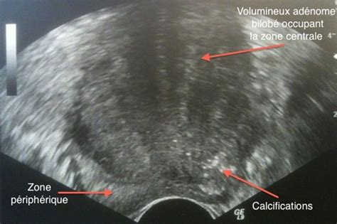 L échographie de la prostate dans le bilan de l adénome de la prostate