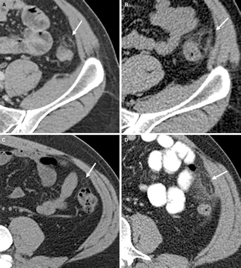 Subacute Epiploic Appendagitis A Arrow Shows Persistent Thickening