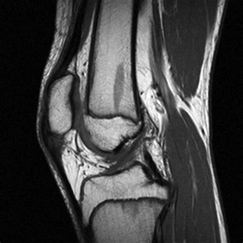 Sinding Larsen Johansson Disease Image Radiopaedia Org