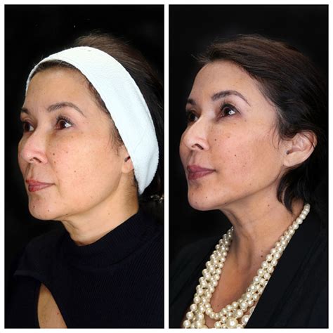 Jawline Contouring Before And After Kaado Md Aesthetics And Anti Aging