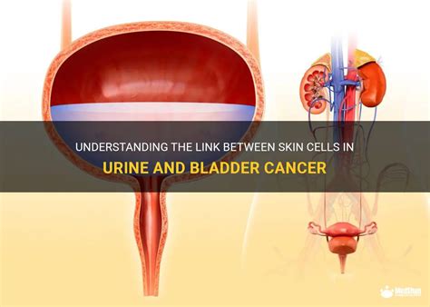 Understanding The Link Between Skin Cells In Urine And Bladder Cancer Medshun