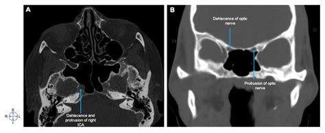 Diagnostics Free Full Text Anatomographic Variants Of Sphenoid Sinus In Ethiopian Population