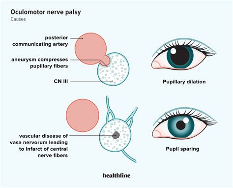 Your Guide To Oculomotor Nerve Palsy And Its Treatment, 52% OFF