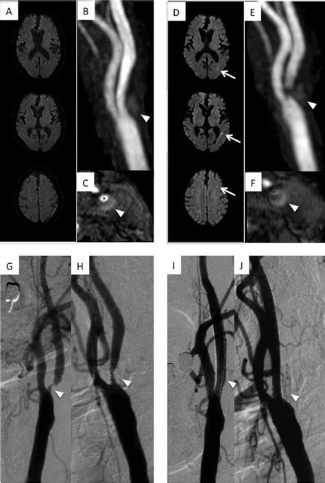 Asymptomatic Moderate Carotid Artery Stenosis With Intraplaque