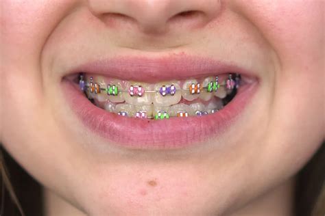 The Best Braces Colors For Girls - Zara Dental Clinic