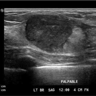 Ultrasound of right breast showing a heterogeneous, hypoechoic nodule ...