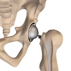 Minimally Invasive Total Hip Replacement Dallas Hip Arthritis Plano