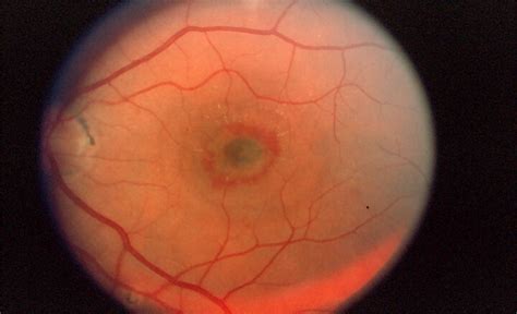 Histoplasmosis Eye