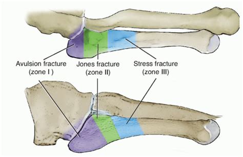 Fifth Metatarsal Fracture Treatment And Tips Metatarsal Fractures