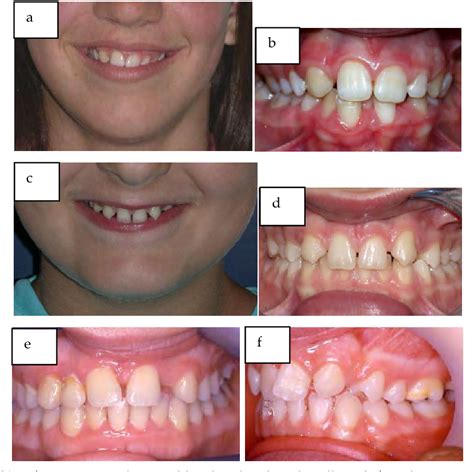 Figure 13 From Maxillary Lateral Incisor Agenesis Mlia Semantic Scholar