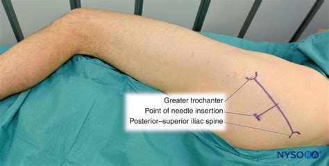 Sciatic Nerve Block