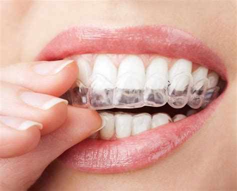 Tips For Taking Care Of Your Invisalign Trays A Caring Dental Group Dentistry