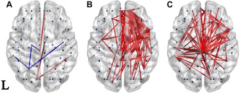 Frontiers Eeg Based Brain Functional Connectivity In First Episode