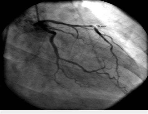 Right Anterior Oblique Caudal View On Coronary Angiogram Two Years