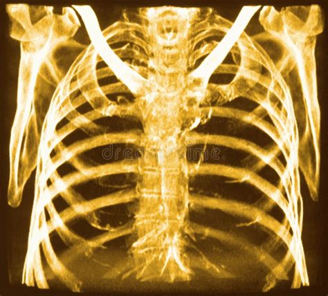Ct Of Chest Bones Stock Image Image Of Lung Disease 13352445