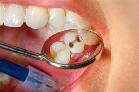 9 Creative Ways To Prevent Cavities Cassell Dentistry San Diego Ca