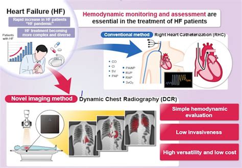 Dynamic Chest X Rays Shows Promise In Patients With Heart Failure