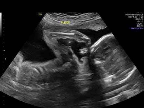 23 Weeks Ultrasound Girl