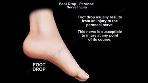 Circuits Diagram For Nerve Potential Of A Foot Drop Foot Dro