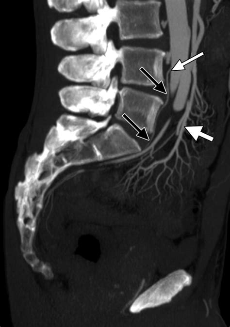 Angiographic Anatomy Of The Male Pelvic Arteries AJR