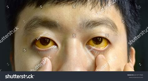 Jaundice In Adults Eyes