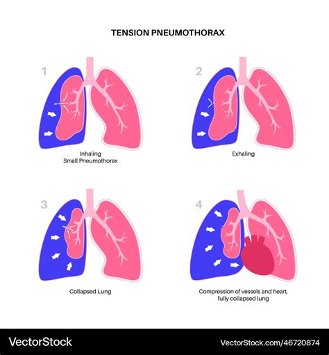 Tension Pneumothorax Poster Royalty Free Vector Image